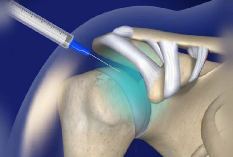 Intraarticular Steroid Injection in Mumbai | Pain Care India