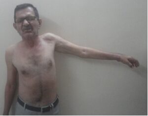 CRPS after internal fixation of wrist and humerus fractures 2