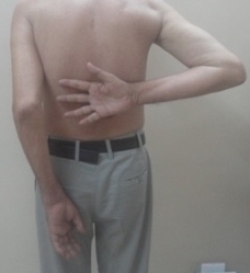 CRPS after internal fixation of wrist and humerus fractures 3