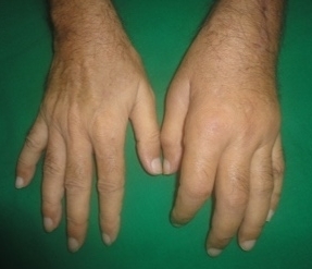 CRPS after internal fixation of wrist and humerus fractures