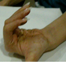 CRPS in a 26-yr-old after metacarpal fracture 18 months prior