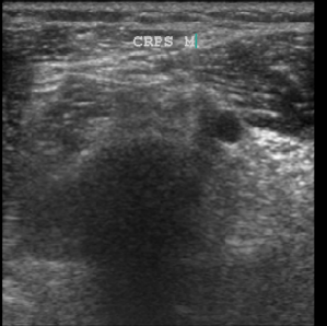 CRPS in a 26-yr-old after metacarpal fracture 18 months prior 2