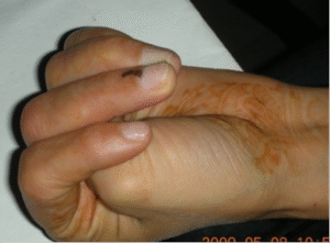 CRPS in a 26-yr-old after metacarpal fracture 18 months prior 3