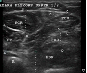 CRPS in a 26-yr-old after metacarpal fracture 18 months prior