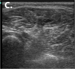 CRPS in a 26-yr-old after metacarpal fracture 18 months prior 5