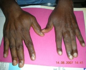 Patient with knife injuries of left forearm and hand 1