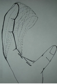 Patient with knife injuries of left forearm and hand 3