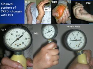 The usual pattern of CRPS recovery at Ashirvad