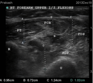 USG showing muscle regeneration at 12 days 5