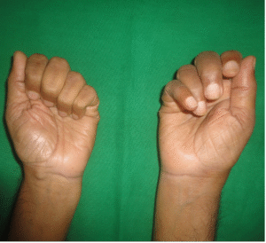 USG showing muscle regeneration at 12 days 6