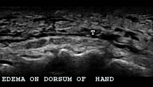 Ultrasound appearance of the inflammation around tendons 1