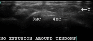 Ultrasound appearance of the inflammation around tendons 3