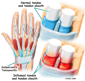 Ultrasound appearance of the inflammation around tendons