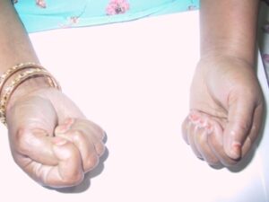 dry needling was used for CRPS 1