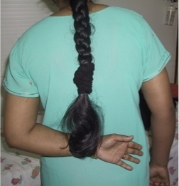 dry needling was used for CRPS 2