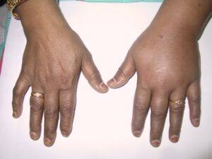 dry needling was used for CRPS