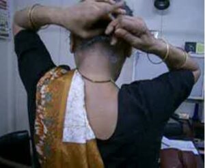 lady with shoulder hand syndrome and the man with Colle’s fracture of wrist 3