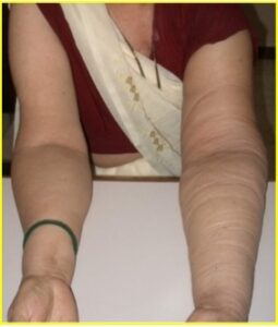 patients with cancer who had CRPS of face after head neck and breast surgery 1