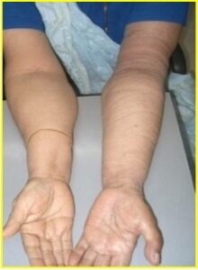 patients with cancer who had CRPS of face after head neck and breast surgery 2