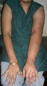 patients with cancer who had CRPS of face after head neck and breast surgery 4