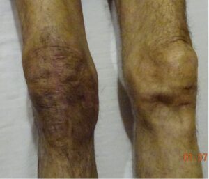 typical appearance of CRPS limbs and face 1