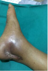 typical appearance of CRPS limbs and face 2