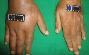 typical appearance of CRPS limbs and face