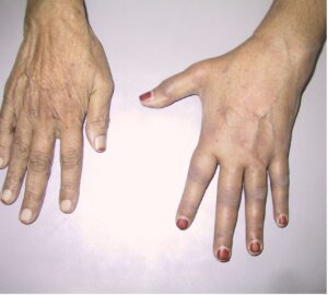 typical appearance of CRPS limbs and face 5