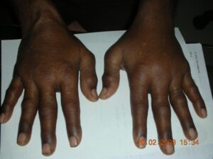 typical appearance of CRPS limbs and face 8
