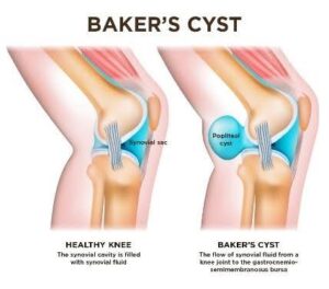 Bakers Cyst