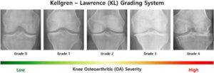 Knee Osteoarthrities
