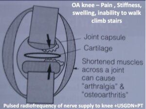 OA KNEE