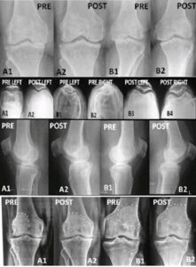 Pulsed Radiofrequency (PRF) of Knee Nerves