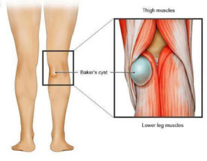 hamstring muscle spasm