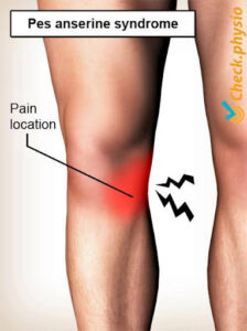 pes anserine syndrome