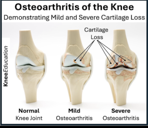 Changes Inside the Knee in OA