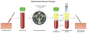 Platelet-Rich Plasma (PRP) Therapy