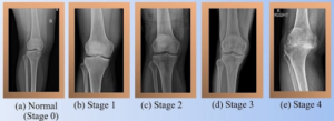 Stages of Knee OA