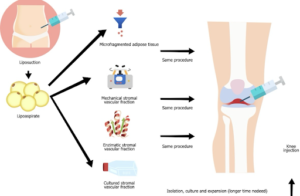 The Double Benefit of Adipose-Derived Stem Cell Therapy